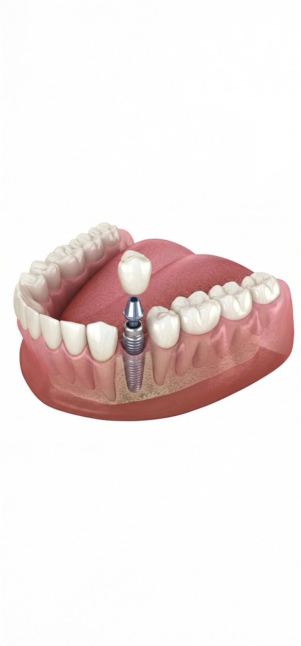 Implantes dentários unitários