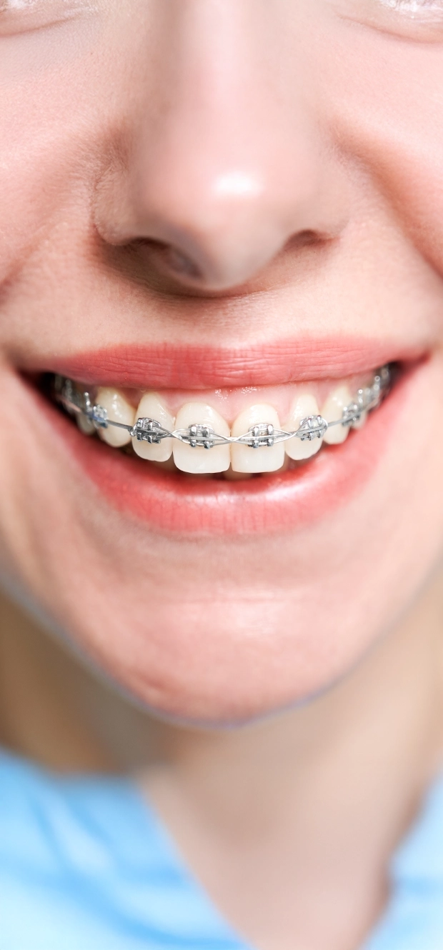 Aparelhos ortodônticos fixos